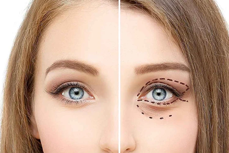 Blefaroplastia (cirugía de párpados) gudalajara