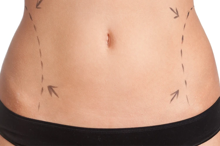 Lipoescultura guadalajara